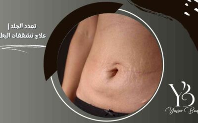 تمدد الجلد | علاج تشققات البطن