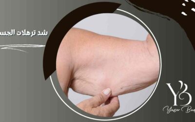 شد ترهلات الجسم
